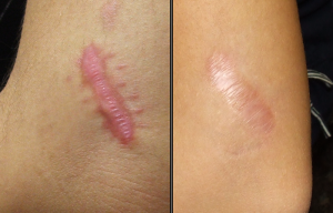 silicone-scar-sheets-before-and-after-300x192