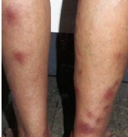 Erythema-nodosum