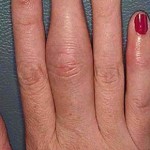 Psoriatic-Arthritis-C