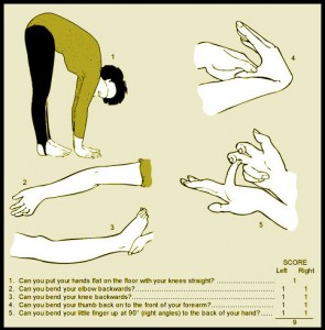 hypermobility