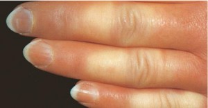m_scleroderma-FH8