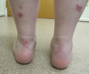 Psoriatic Arthritis: Enthesitis, Ankle