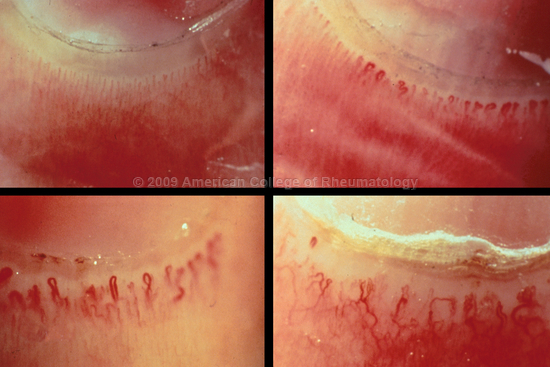 Dermatomyositis and Scleroderma: Periungual Involvement