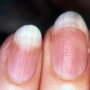 psoriasis-nail-finger-400x400