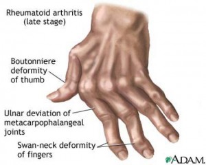 rheumatoidarthritishand