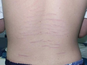 striae-puberteit-2